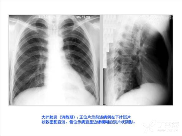 照片名称:大叶肺炎-消散期