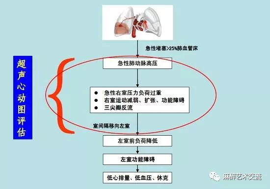 肺栓塞解读