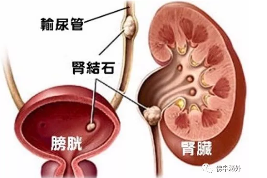 结石药的原理_所以根据我们人自身的生理特点,理论上最大横径为0.6cm以下的结石都可以用药物