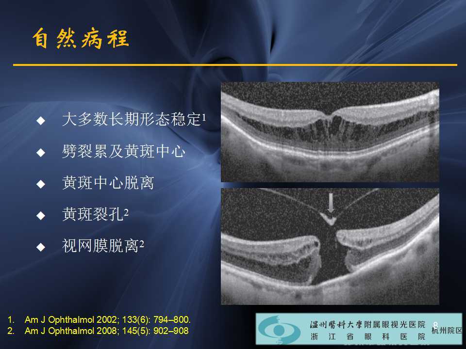 高度近视黄斑劈裂