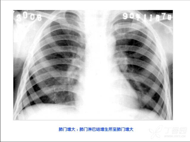 胆囊结石照片名称:胸腔少量积液照片名称:胸膜肥厚粘接钙化照片名称