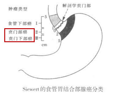 贲门癌一定要做全胃切除吗?