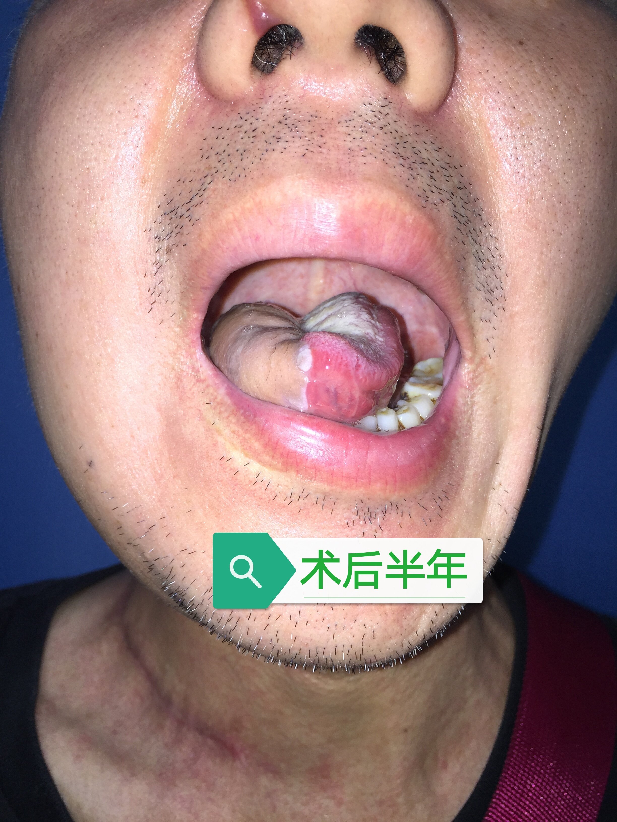 舌癌的手术治疗(附术前,术后照片)_肿瘤