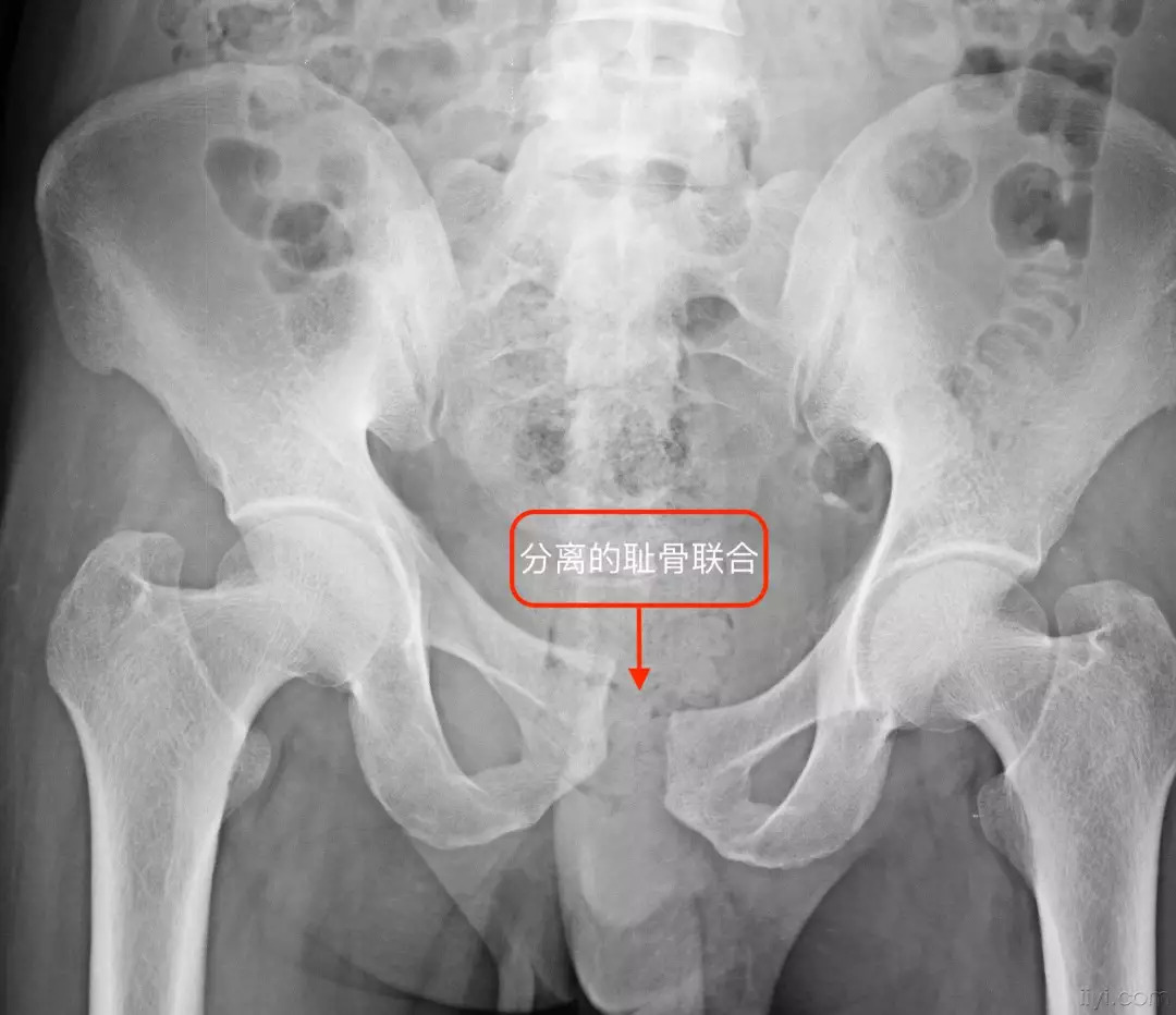 骨盆骨折 - 损伤及中毒 - 《默沙东诊疗手册大众版》