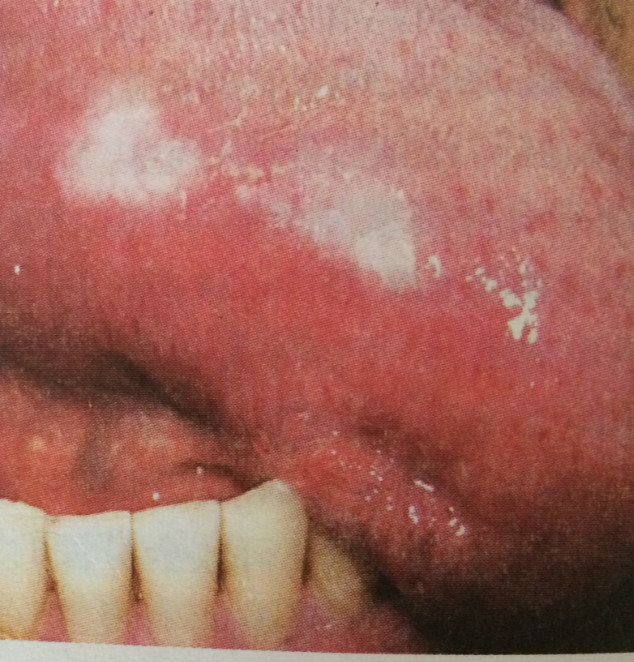 口腔真菌感染图片