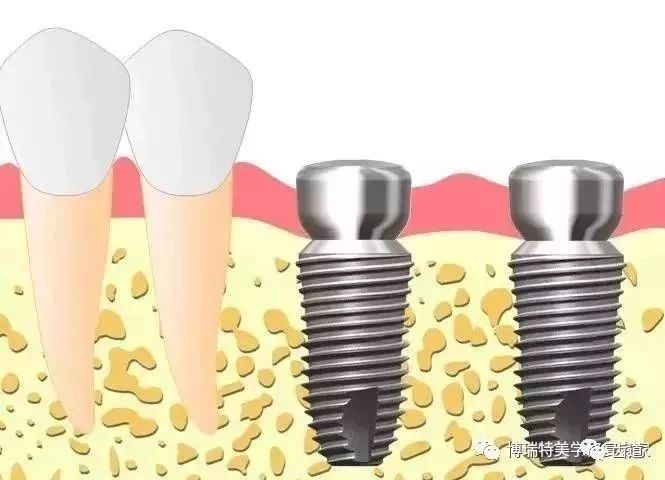 1.2 取出愈合基台