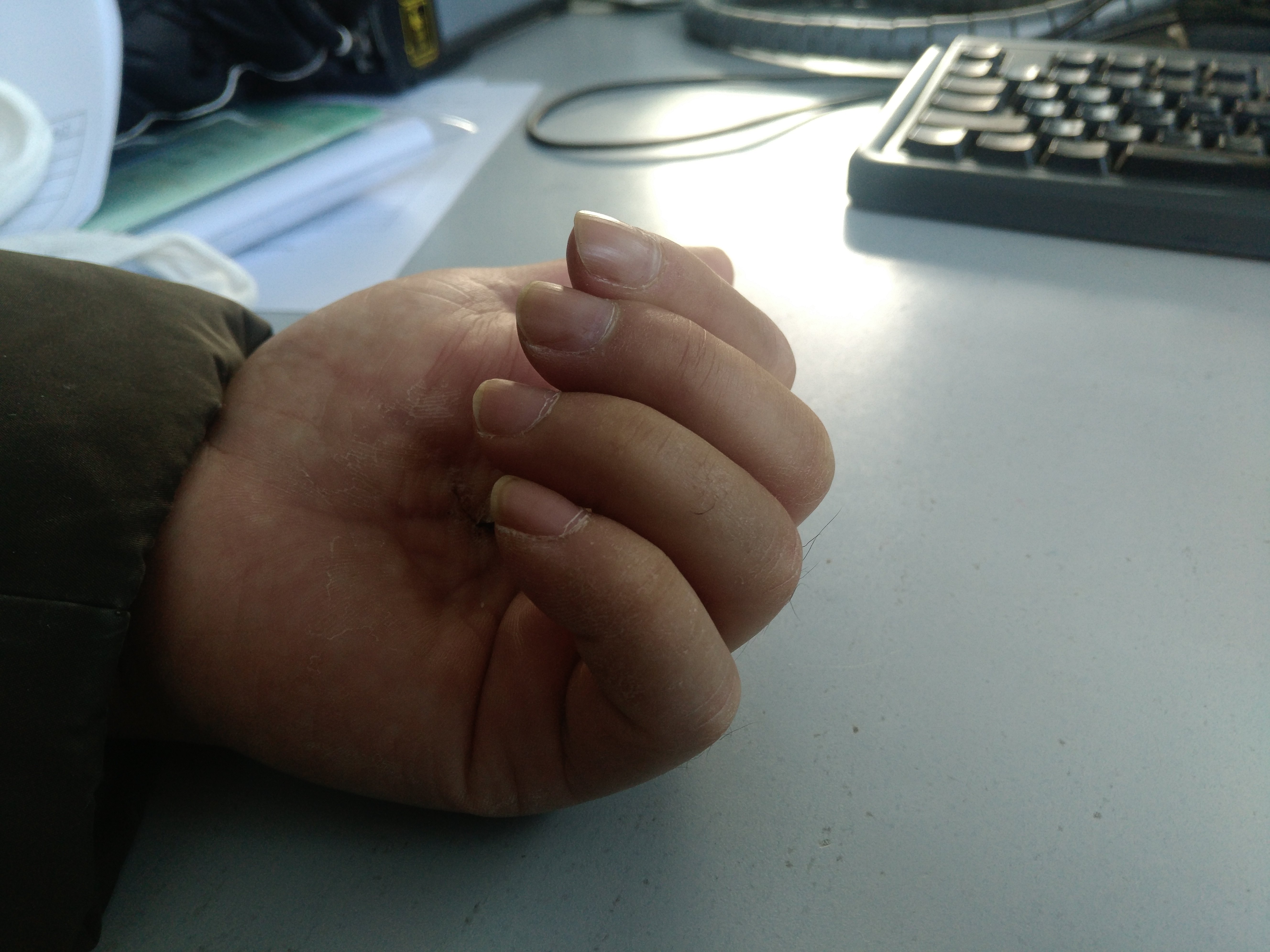 黄威科普：什么是3D打印断指再造,真的能再造缺失的手指吗？_中华网