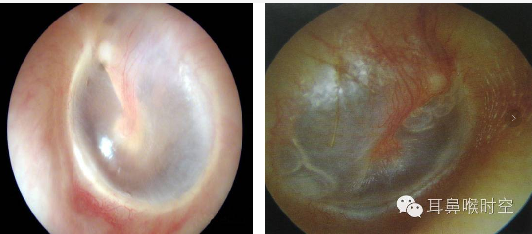 分泌性中耳炎vs急,慢性中耳炎,细说中耳疾病的重点辨别 (转载)
