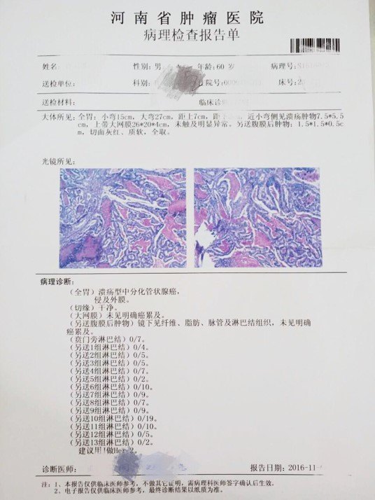 胃癌手术淋巴结清扫的重要性