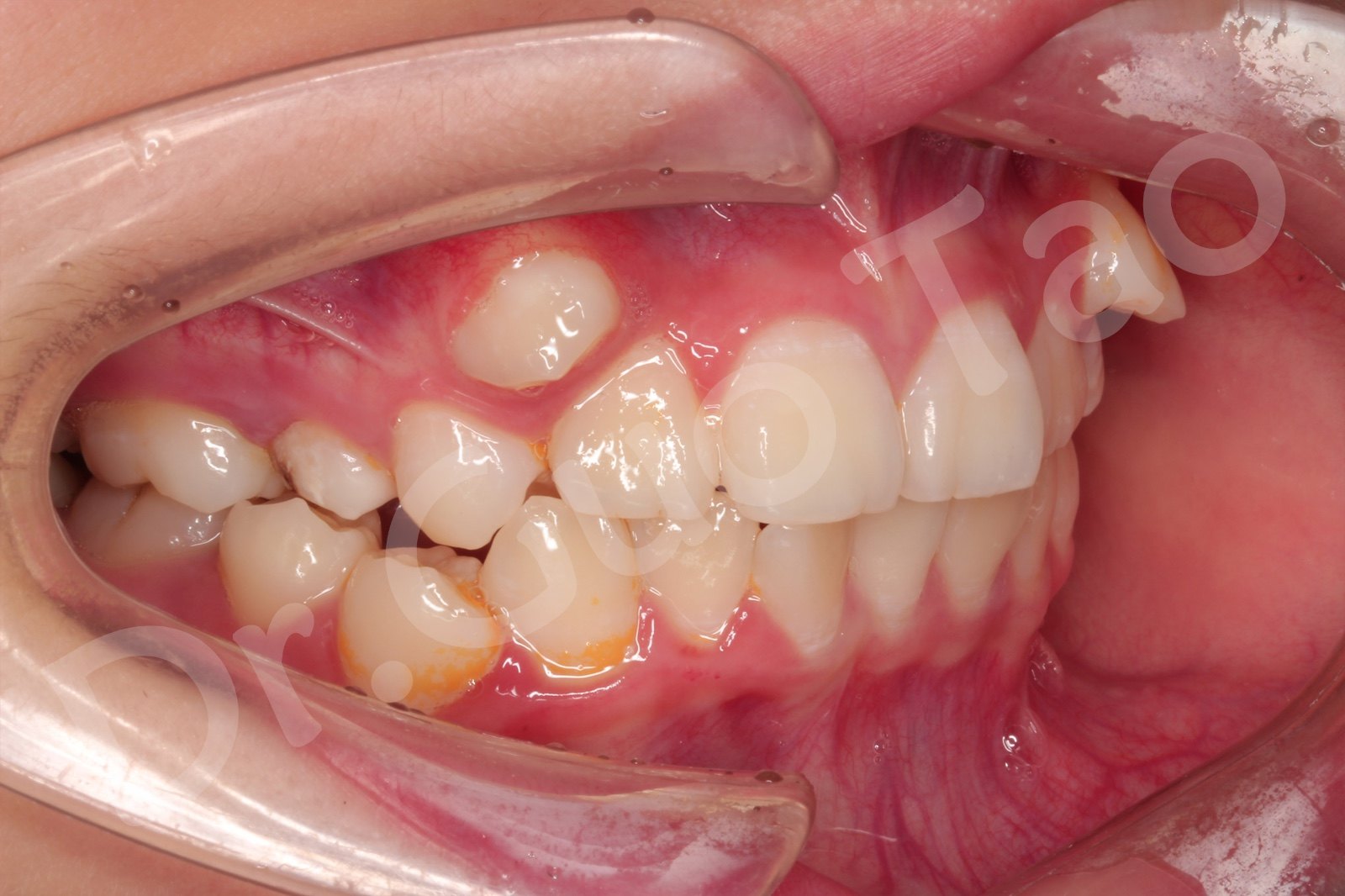 如何更有效的向医生咨询牙齿矫正问题?