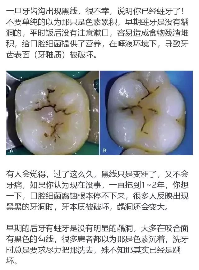 当你的后牙出现黑线,牙齿已"亮起红灯"