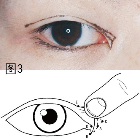 三分钟教你认识内眦赘皮