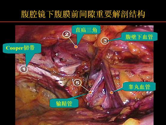腹股沟区局部的解剖和手术方式