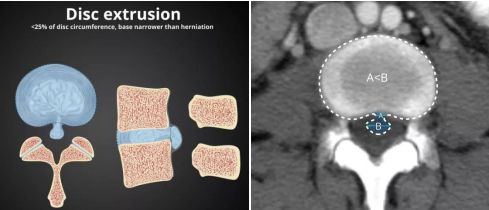 2分钟教你快速鉴别椎间盘膨出,突出与脱出