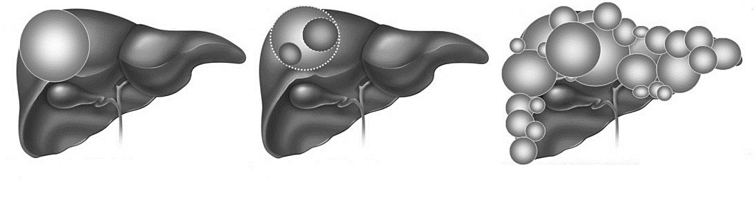 有关肝囊肿的十大常见问题_囊肿壁