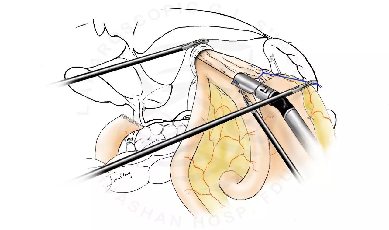 图解splt——全腹腔镜全胃切除后重建的新方式
