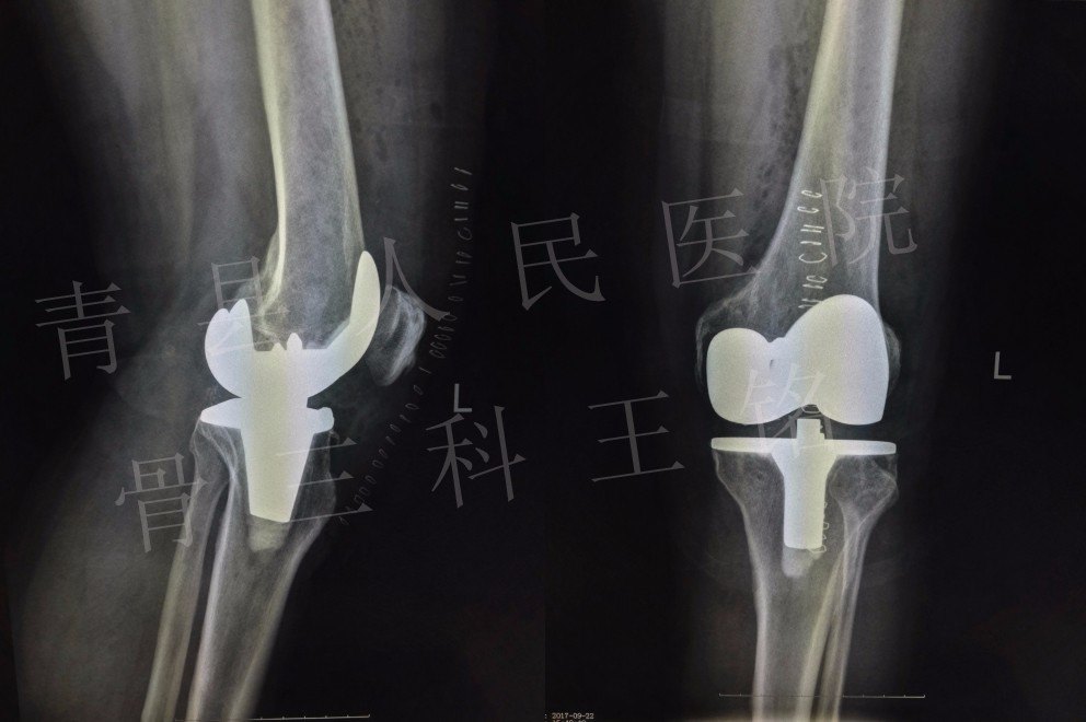 膝关节骨性关节炎(重度)-行人工全膝关节置换术后x线片