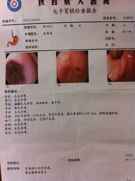 疗后胃镜报告