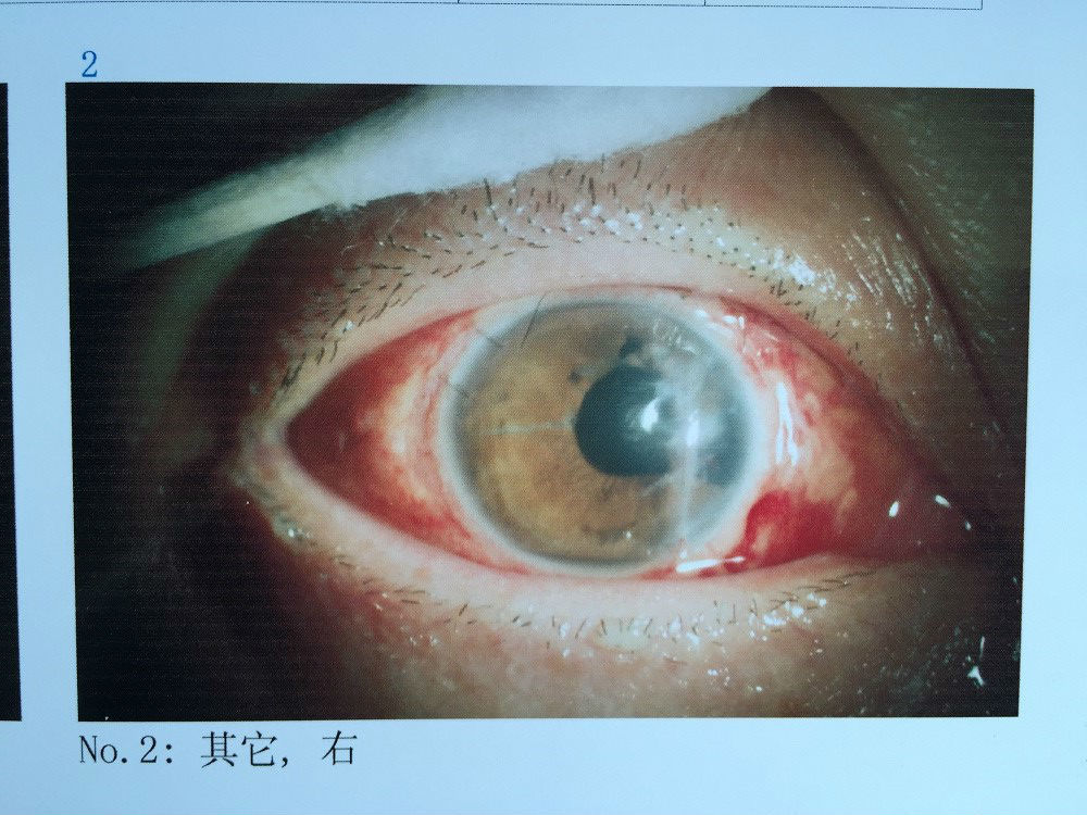 虹膜断离/缺损 瞳孔散大修复的病例