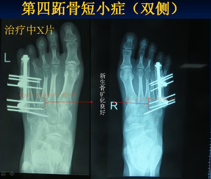 第四跖骨短小症(双足典型病例)杨华清矫形骨科 (转载)