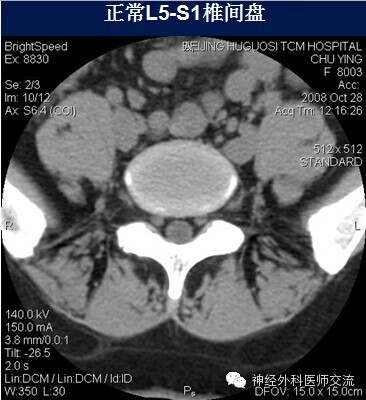 腰椎间盘膨出突出椎管狭窄ct诊断 (转载)