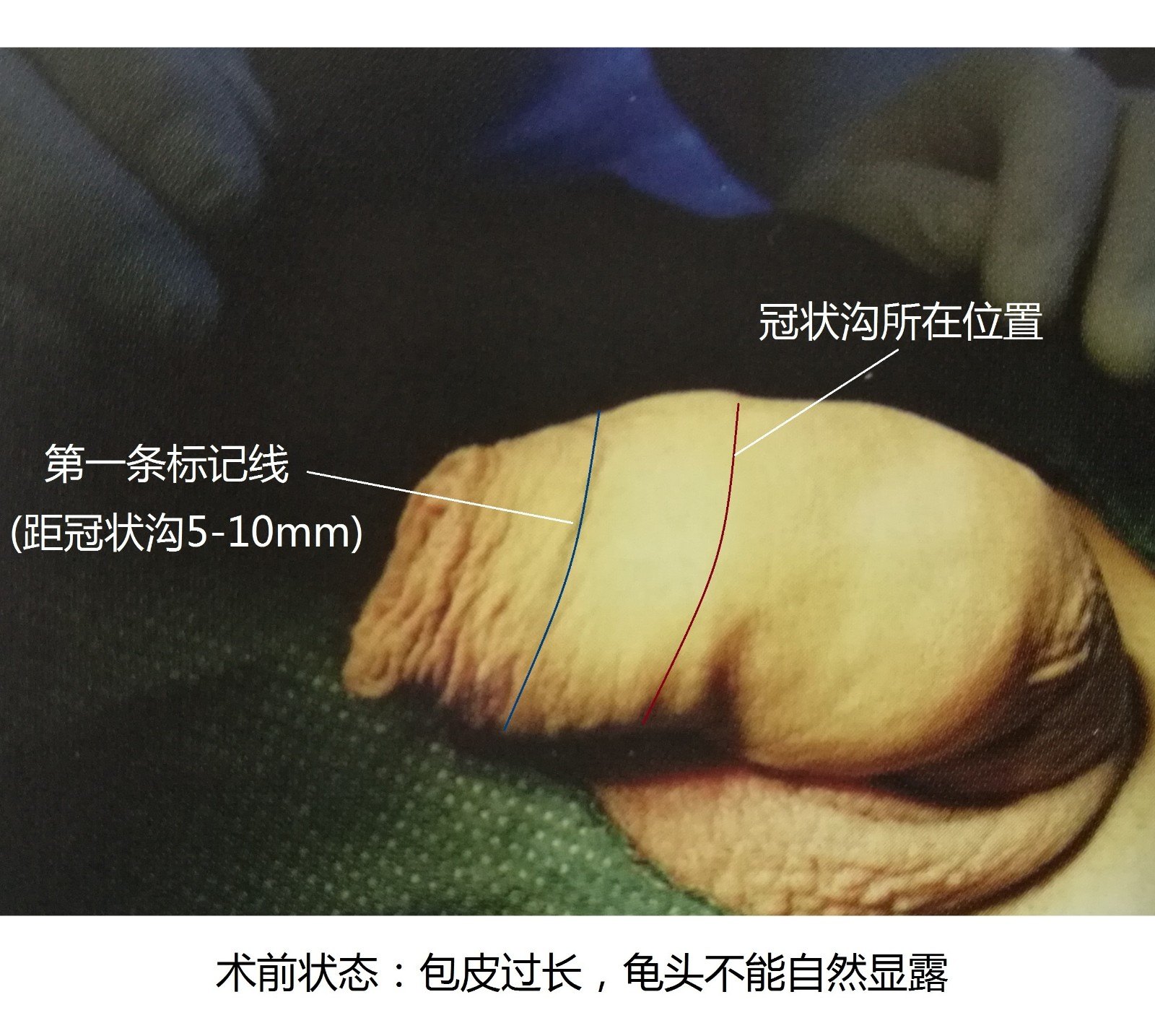 包皮的原理_二、什么状况的包皮应该割?