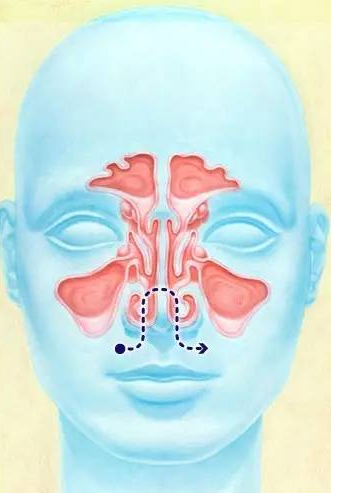 儿童鼻-鼻窦炎的鼻腔冲洗治疗 (转载)