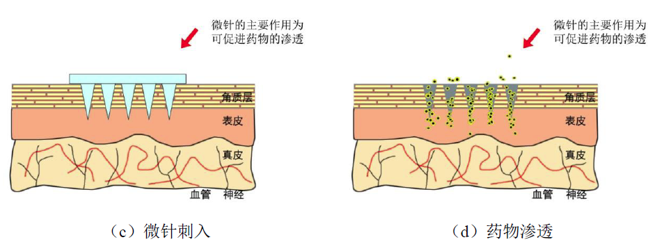 最实用的微针干货