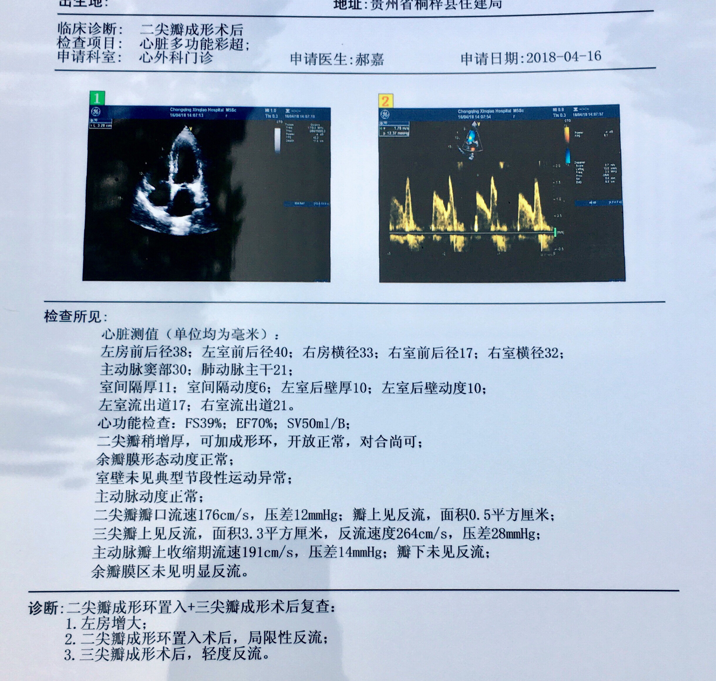 二尖瓣关闭不全是直接换瓣还是先考虑成形修复?