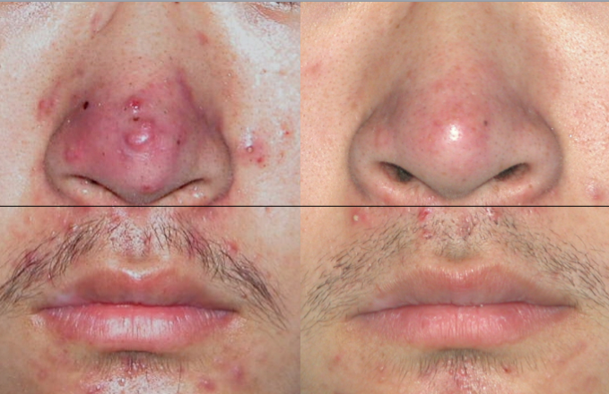 鼻赘期:点阵激光进行磨削,一般3次左右,间隔2-3个月1次.