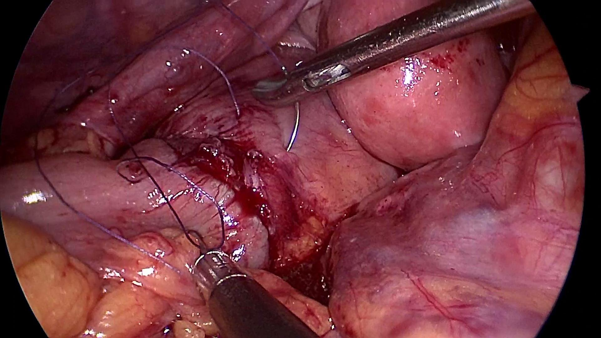 腹腔镜乙状结肠癌根治术手术步骤