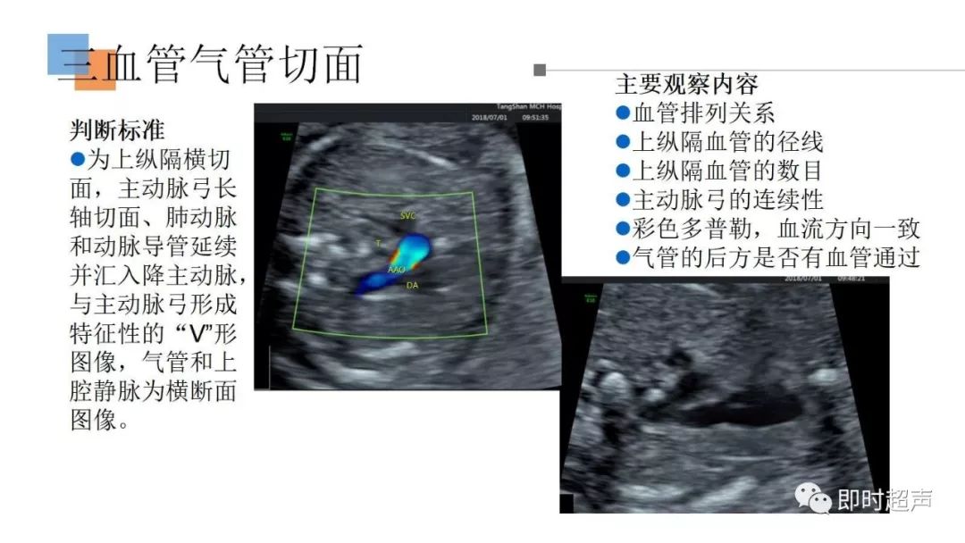 左室流出道切面 右室流出道切面 三血管切面 三血管气管切面 主要