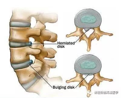 腰突的原理_白领司机腰突真的可以治愈么