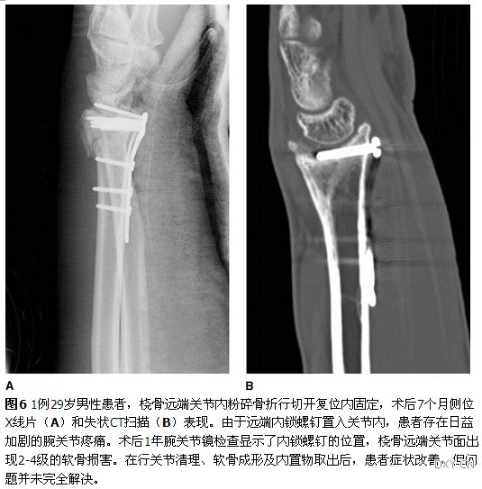 桡骨远端骨折掌侧钢板固定的并发症