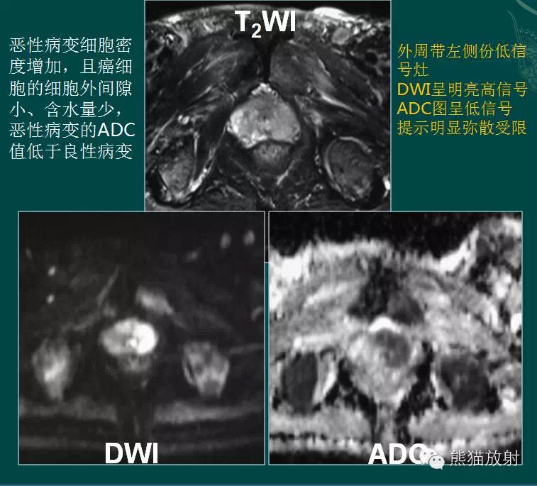 前列腺癌的mri诊断 (转载)