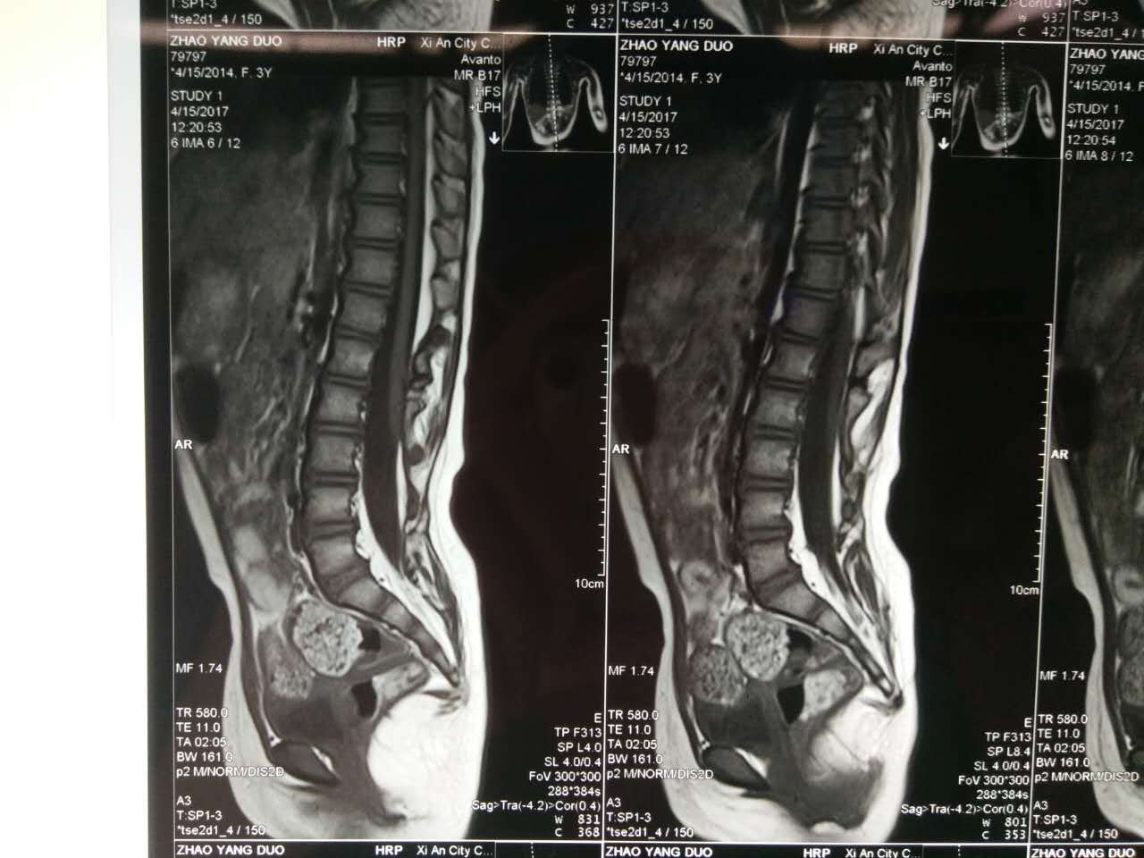 先天性脊柱裂--——脊髓拴系综合症(微创治疗)