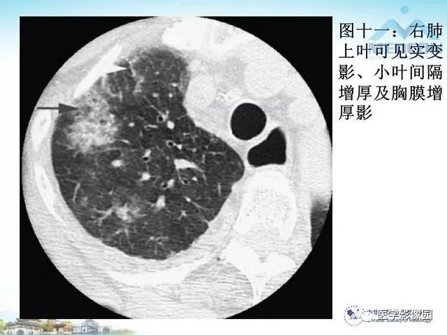 克雷伯杆菌肺炎ct表现影像天地