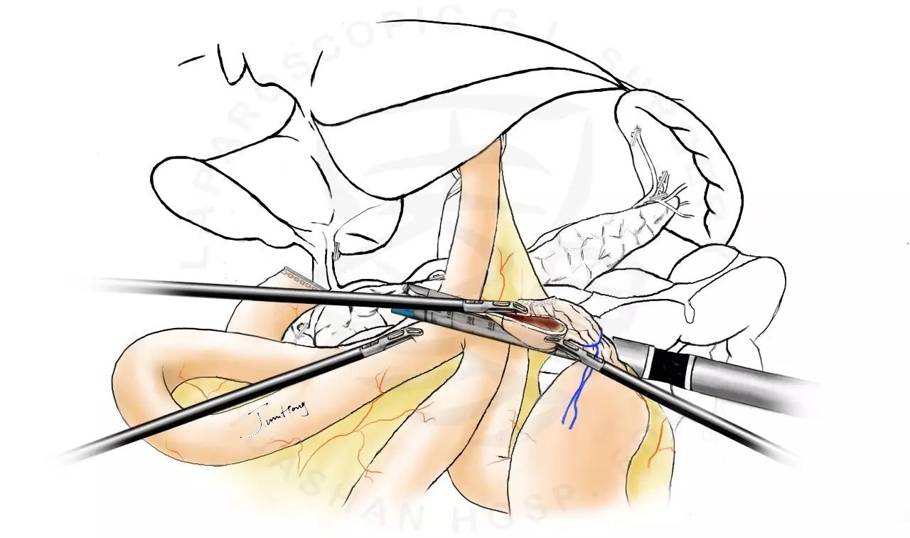 图解splt——全腹腔镜全胃切除后重建的新方式
