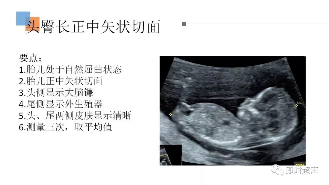 nt标准切面