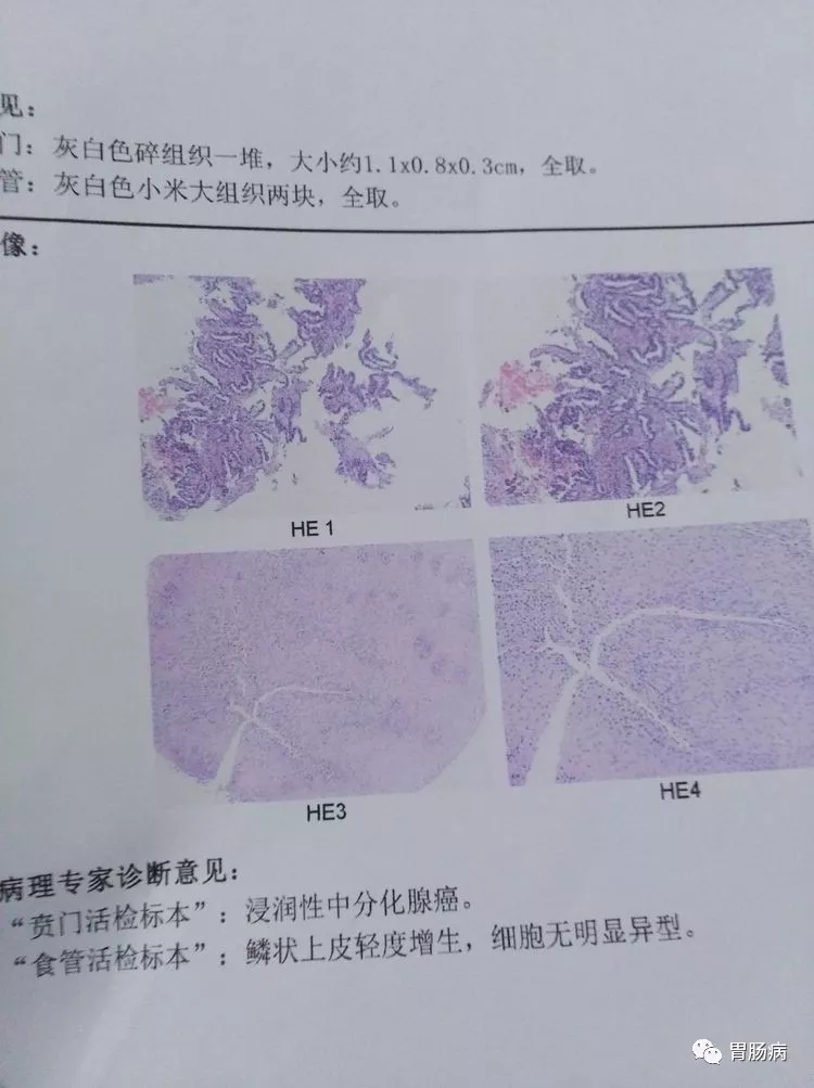 镜子下到食管下段就看到一处占位性病变,再往下贲门口及内缘均见一