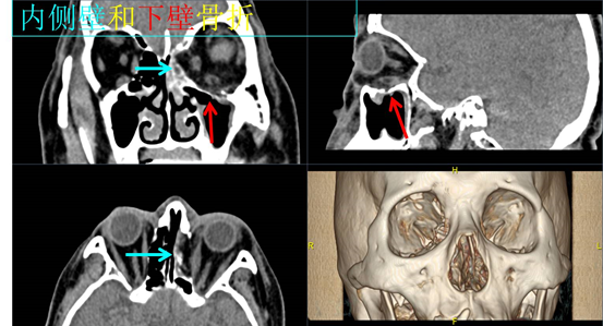 眼眶骨折的ct表现