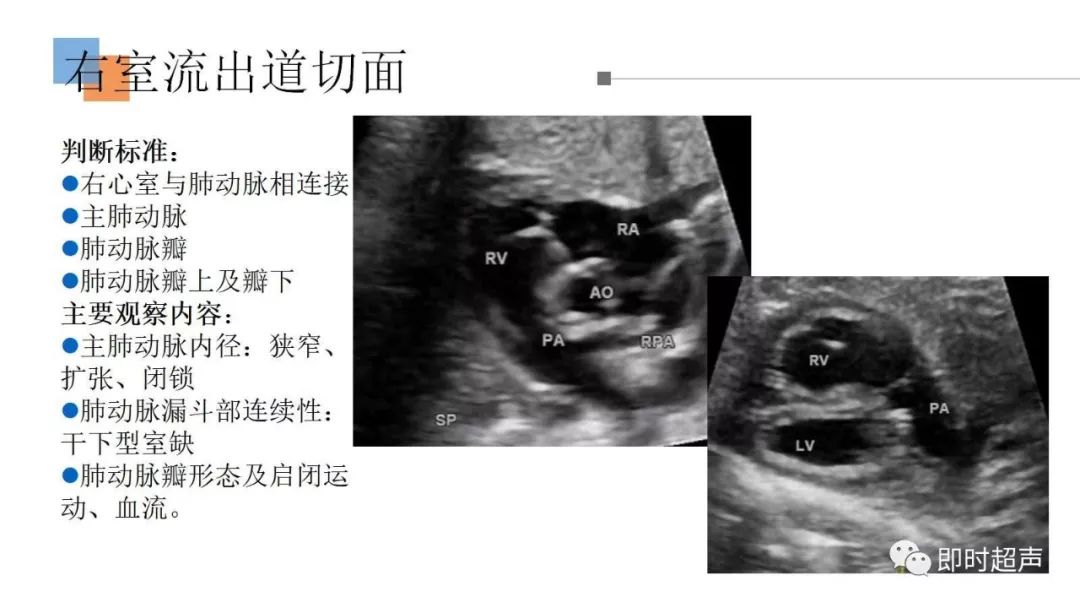 【回顾】产前超声筛查的临床心得