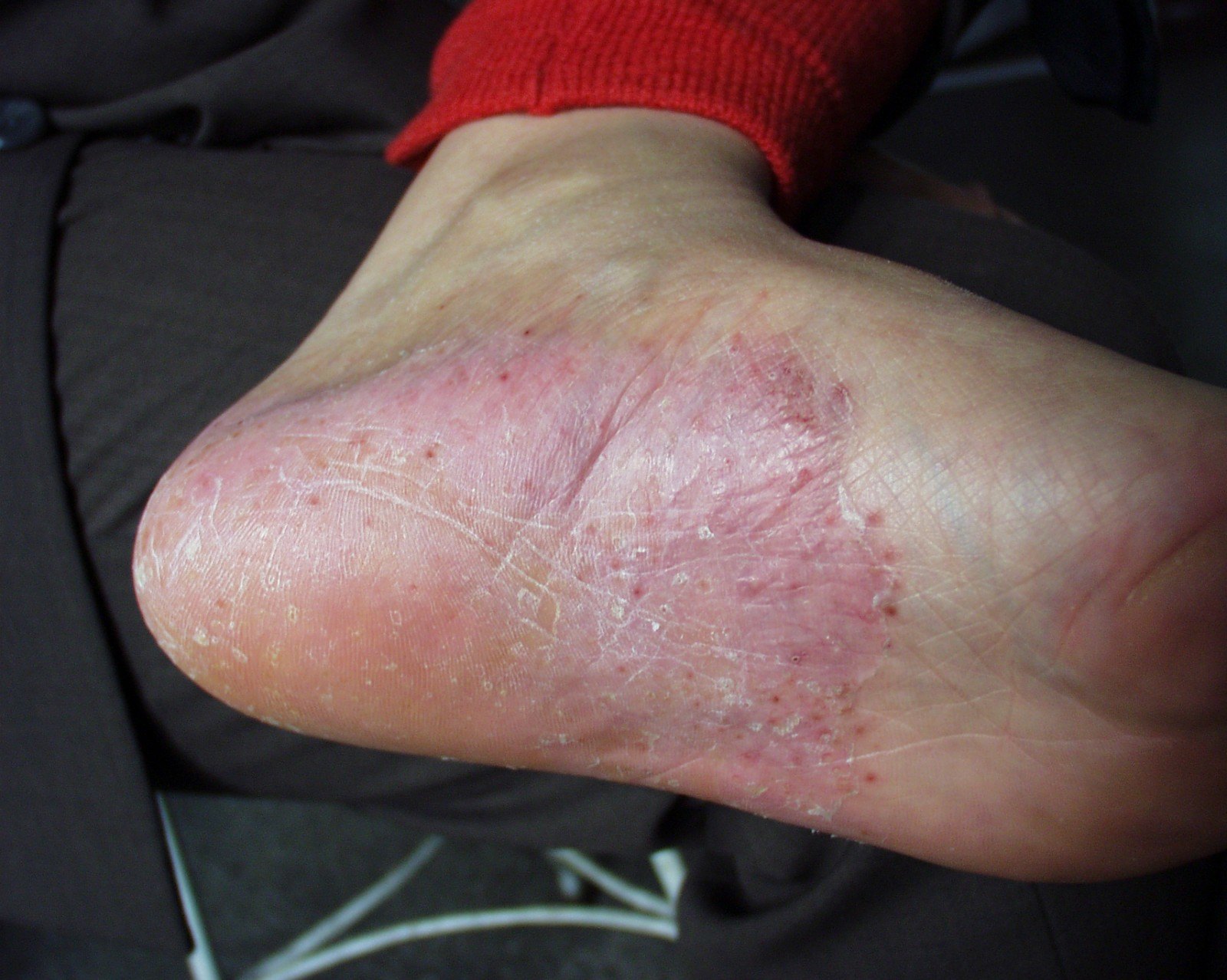 脚底真菌感染图片初期,真菌脚气 - 伤感说说吧