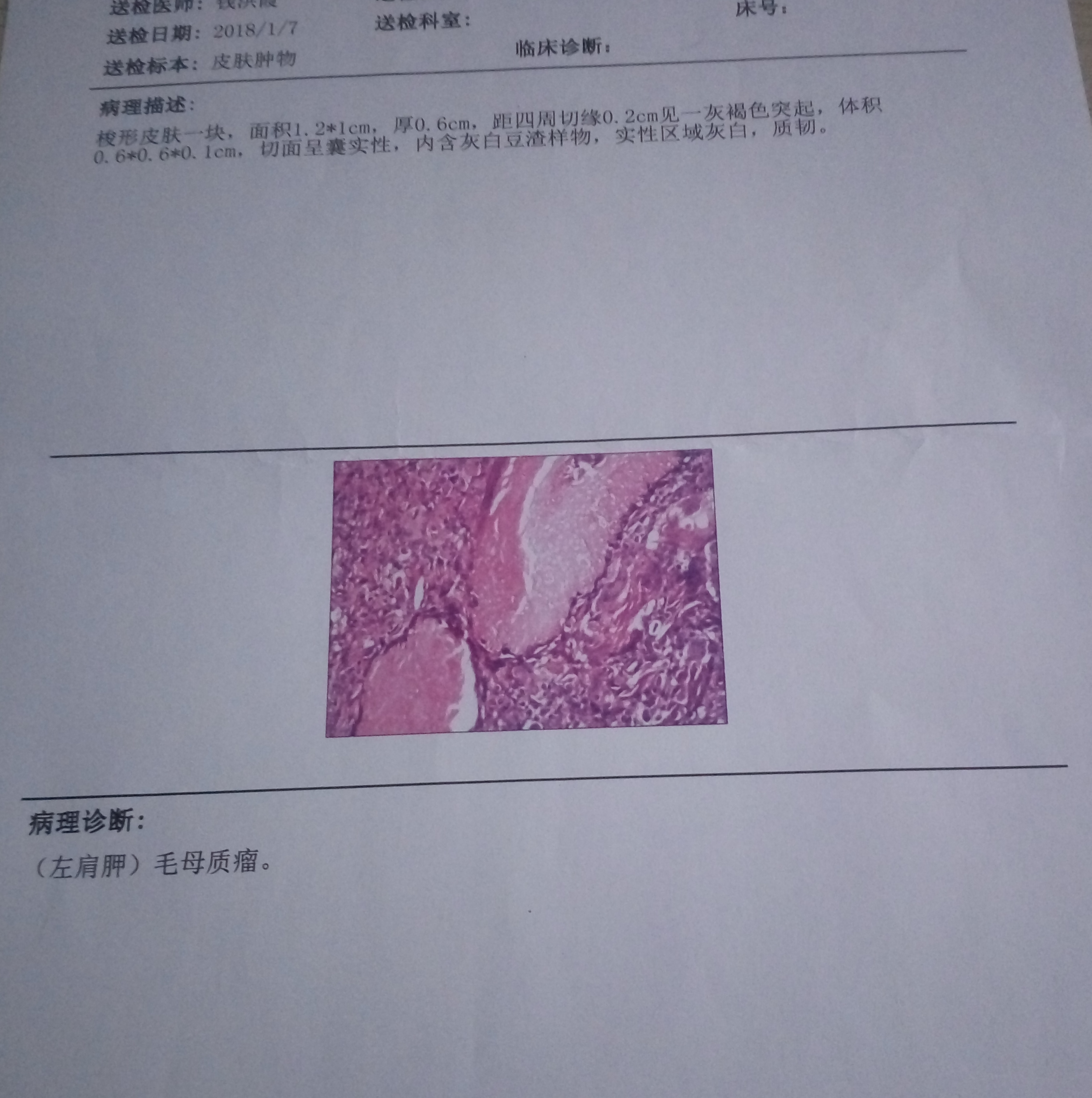 毛母质瘤又称钙化上皮瘤,是源自向毛母质细胞分化的原始上皮胚芽细胞