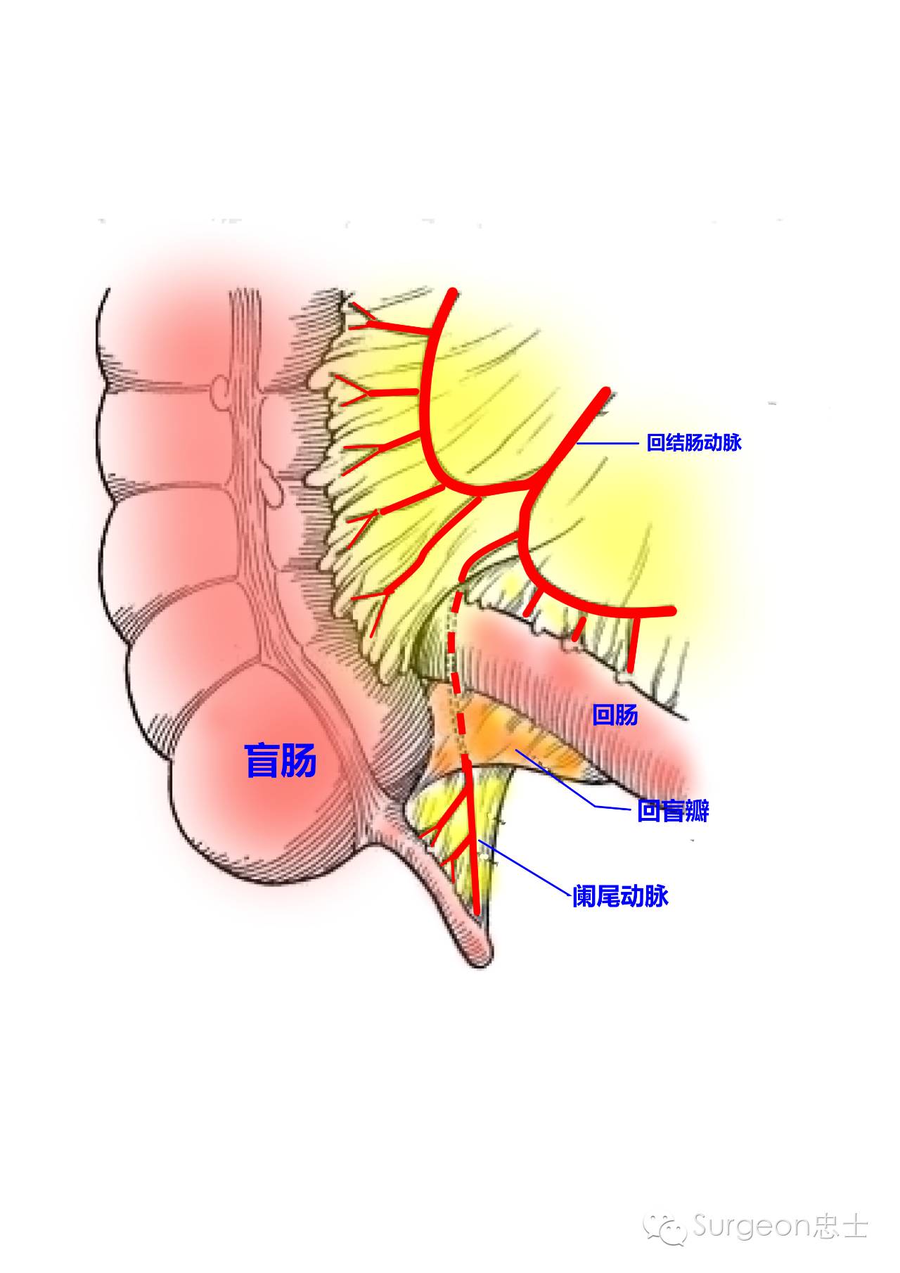 图文示教 | 腹腔镜阑尾切除术