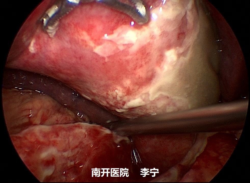 急性梗阻性化脓性胆囊炎