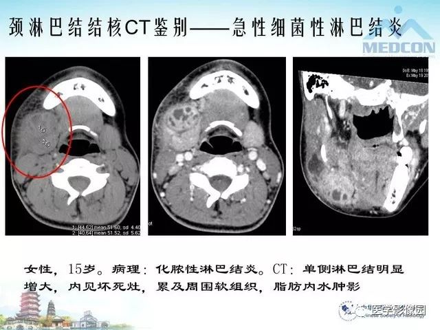 颈部淋巴结结核msct表现及鉴别影像天地