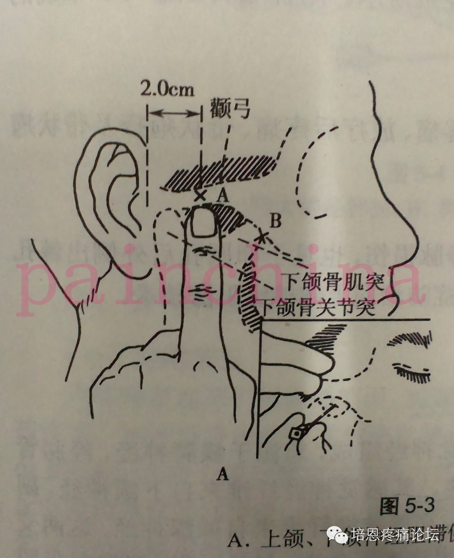 疼痛科常用神经阻滞适应证,解剖点位,操作要点及并发症预防. (转载)