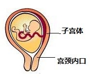 一种治疗宫颈内口松弛的新技术高位宫颈环扎术