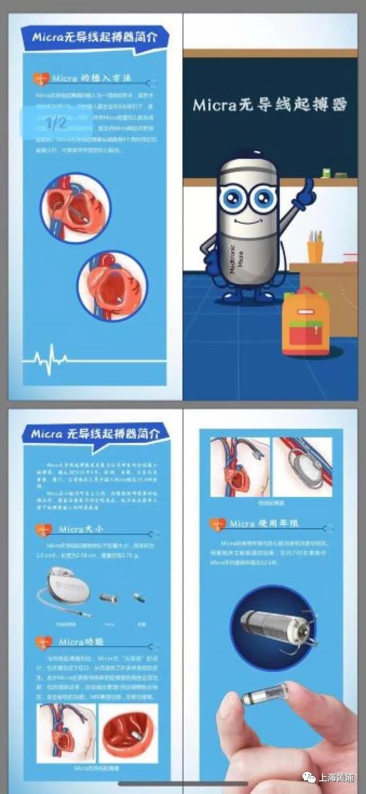 很多心脏病人有望用上"胶囊"起搏器目前在中国进行上市前研究,上市前